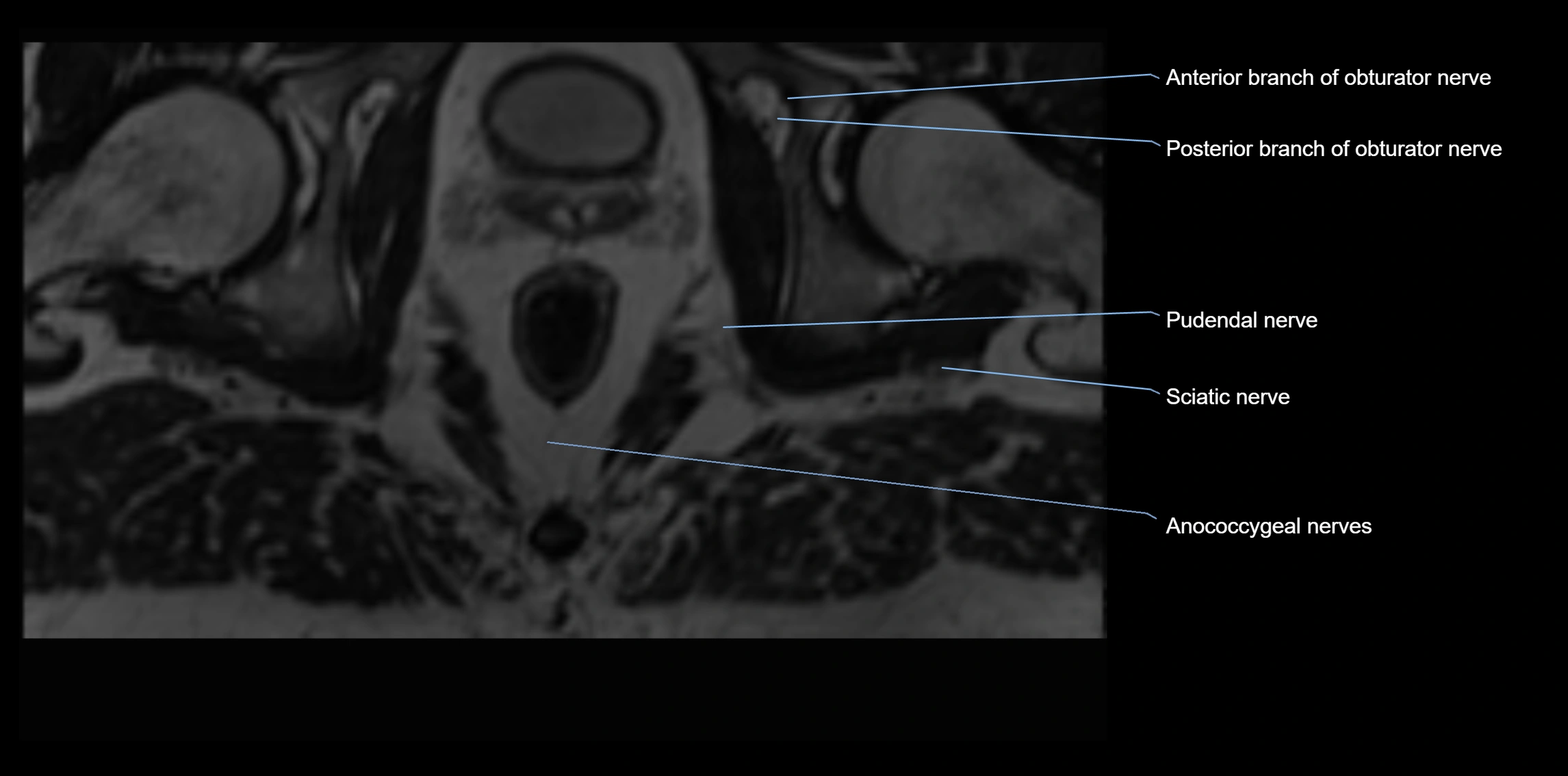 MR lumbosacral plexus axial cross sectional anatomy 3T  radiology  image-img-1008001-00129.webp